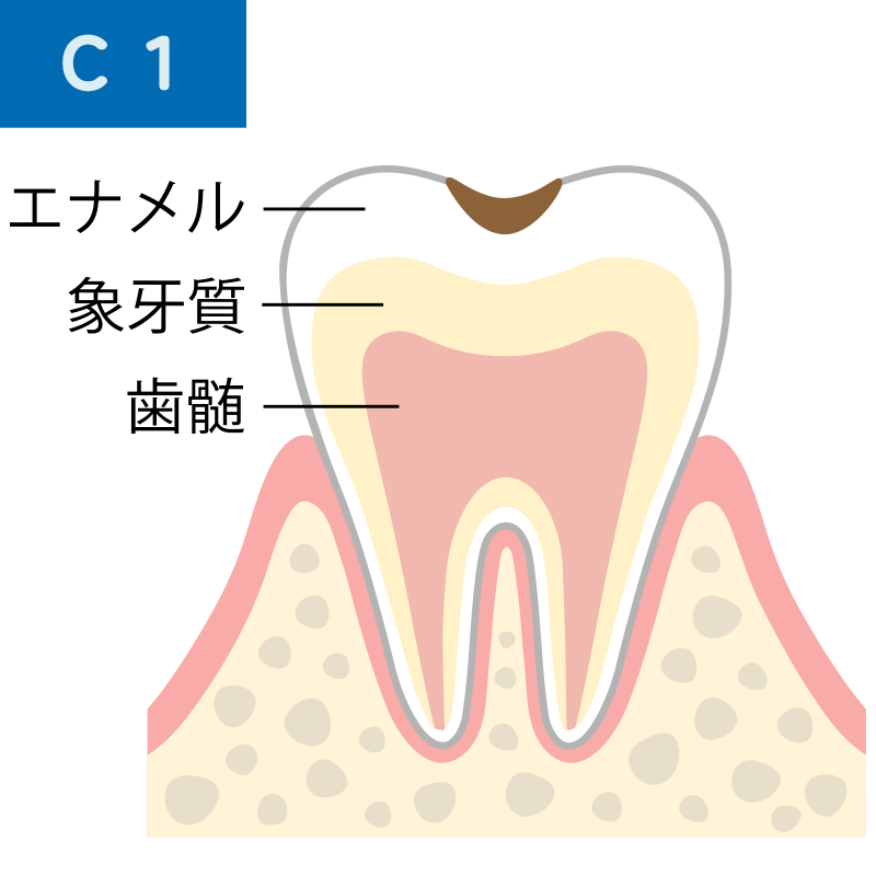 C1 エナメル質の虫歯