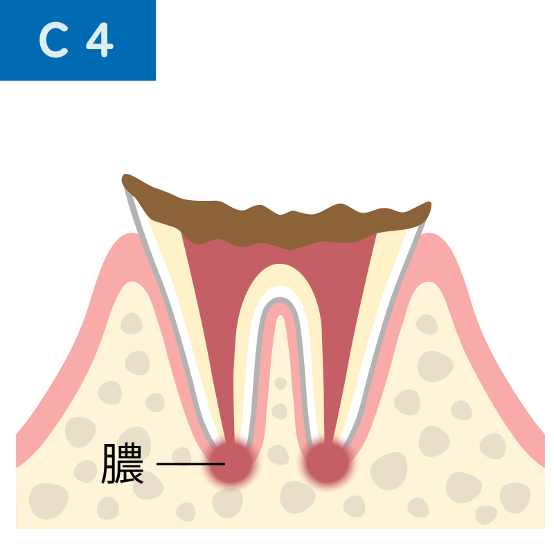 C4 歯根に達した虫歯