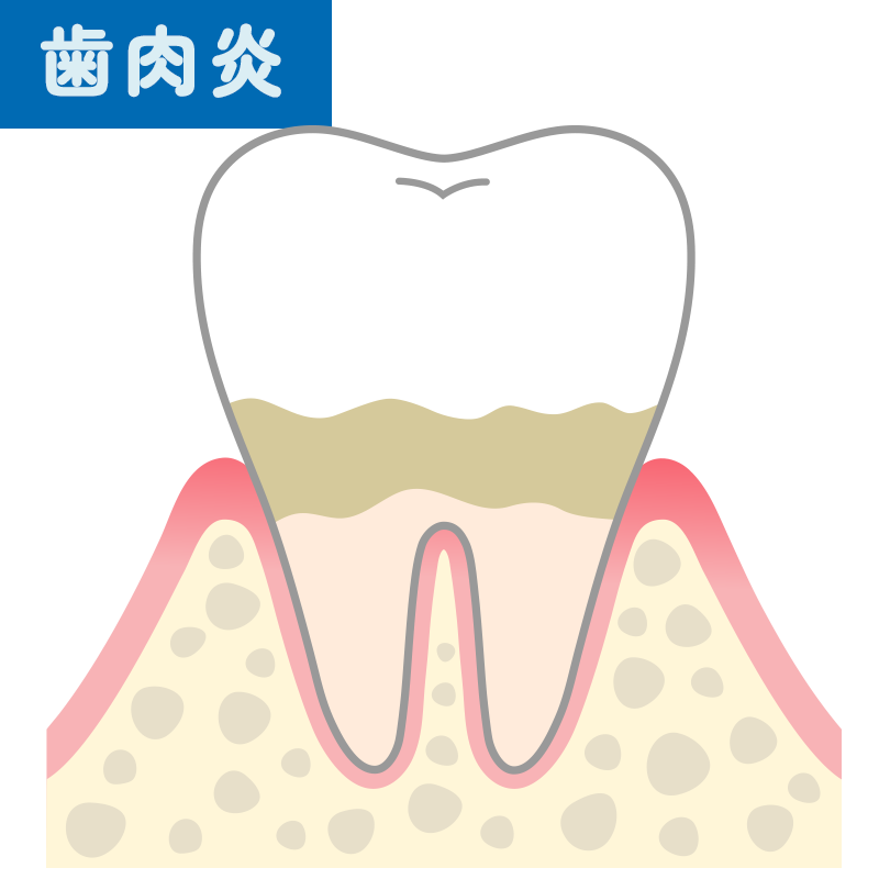 歯肉炎