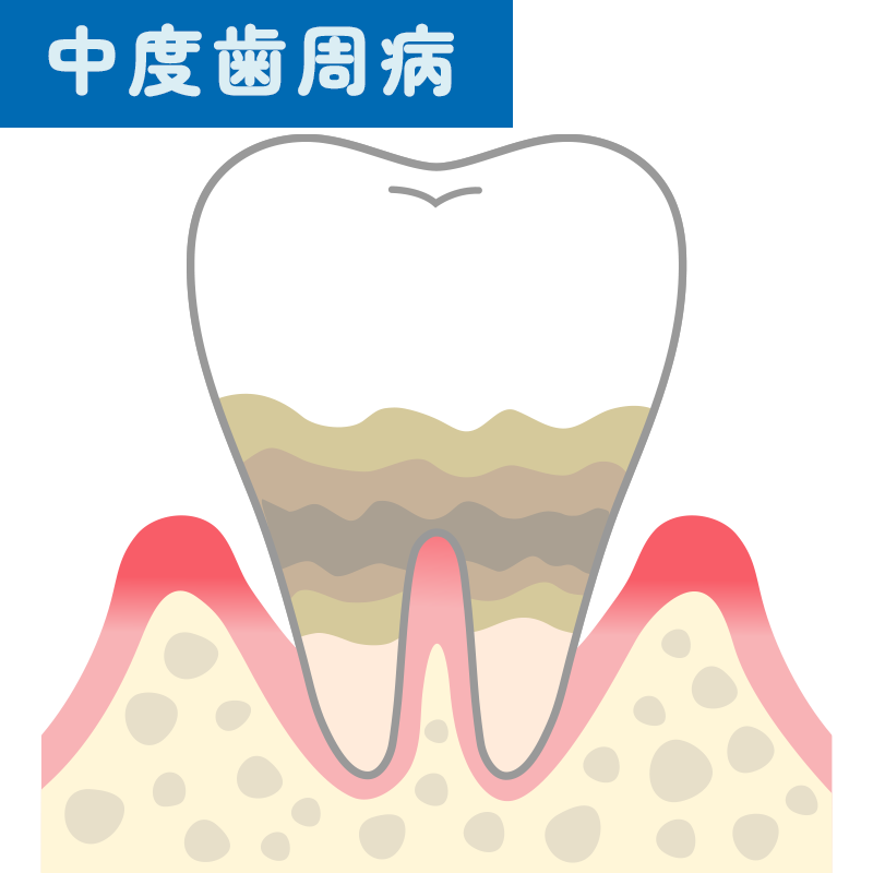 中度歯周病